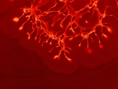 Visão embaçada pode ser sinal de aneurisma cerebral